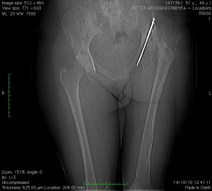 1 displasia con esiti osteotomia di bacino